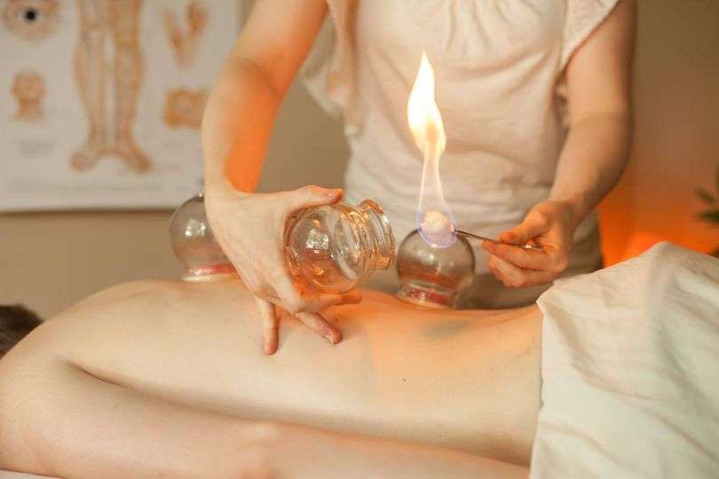 Fire cupping therapy treatment session.