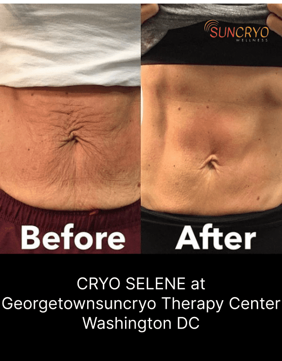 CRYO SELENE at Georgetownsuncryo Therapy Center Washington DC