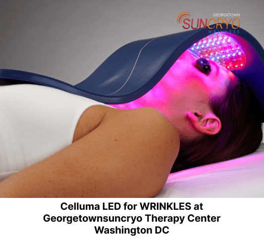 Celluma LED for WRINKLES at Georgetownsuncryo Therapy Center Washington DC