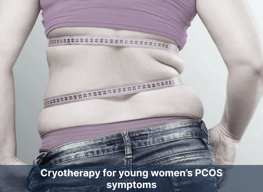 Cryotherapy for young women’s PCOS symptoms