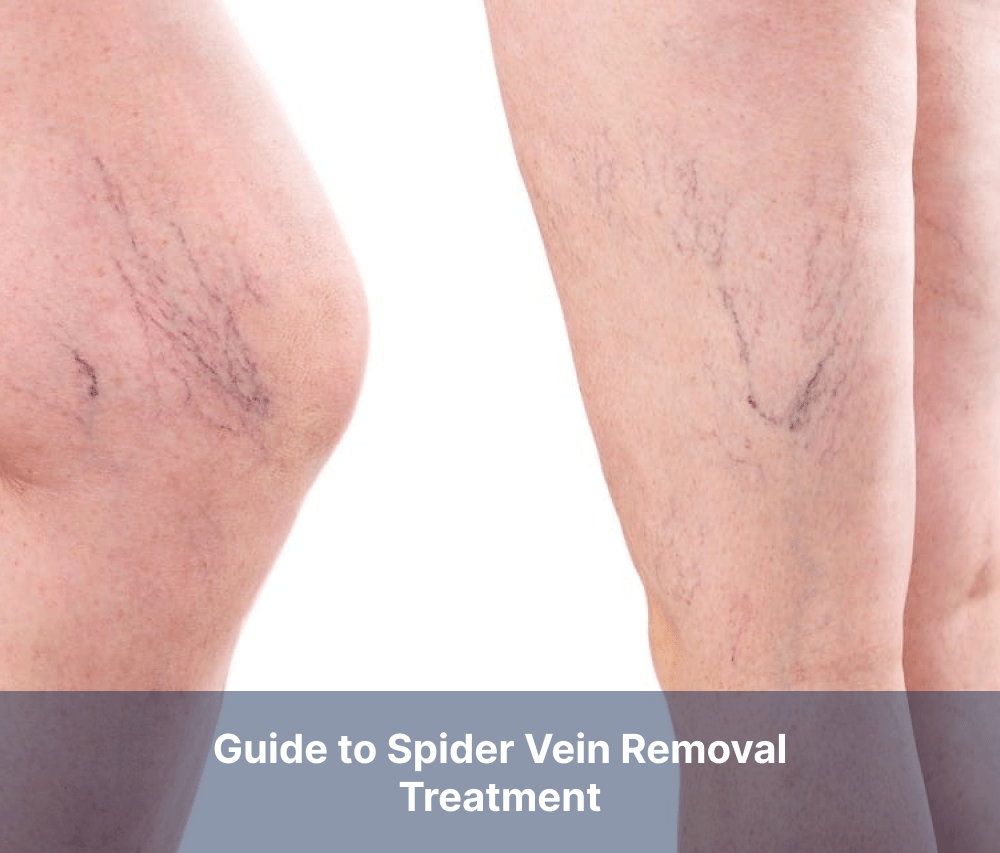 Guide to Spider Vein Removal Treatment