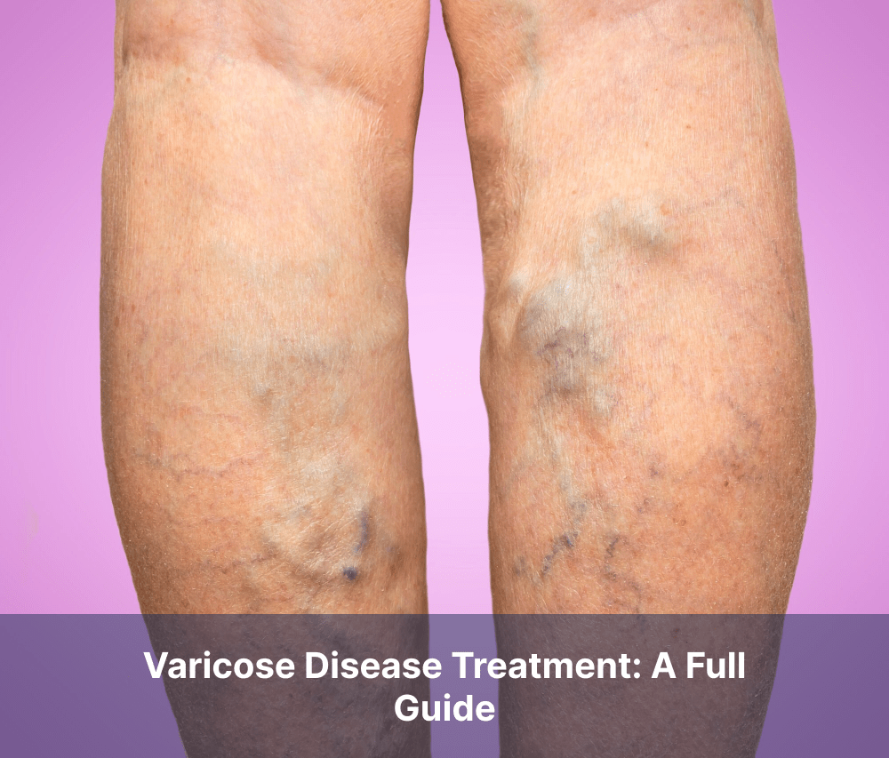 Varicose Disease Treatment: A Full Guide