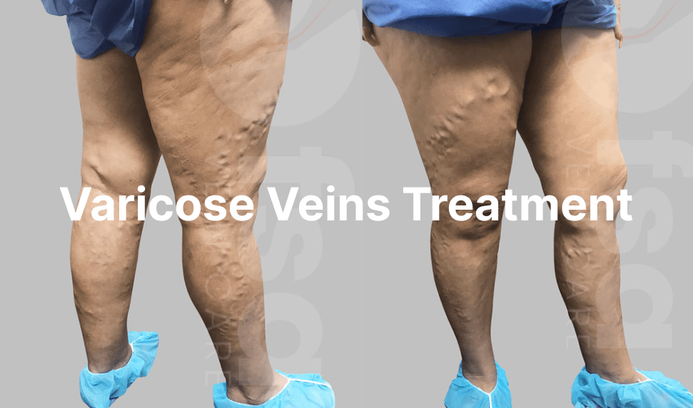 Varicose Veins Treatment