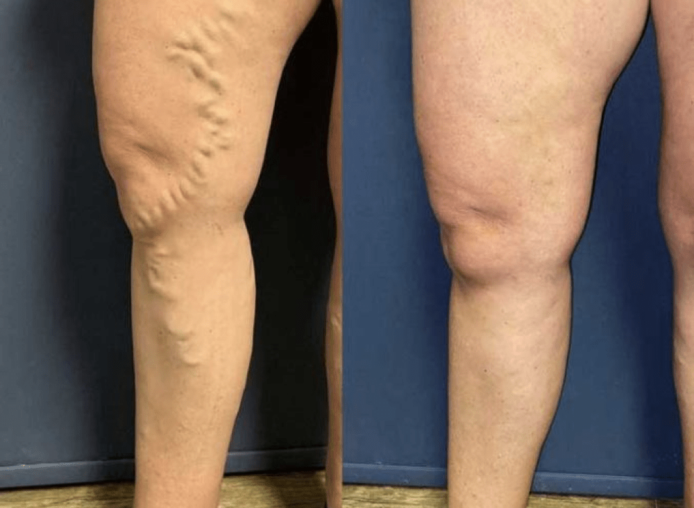 Varicose Veins Treatment