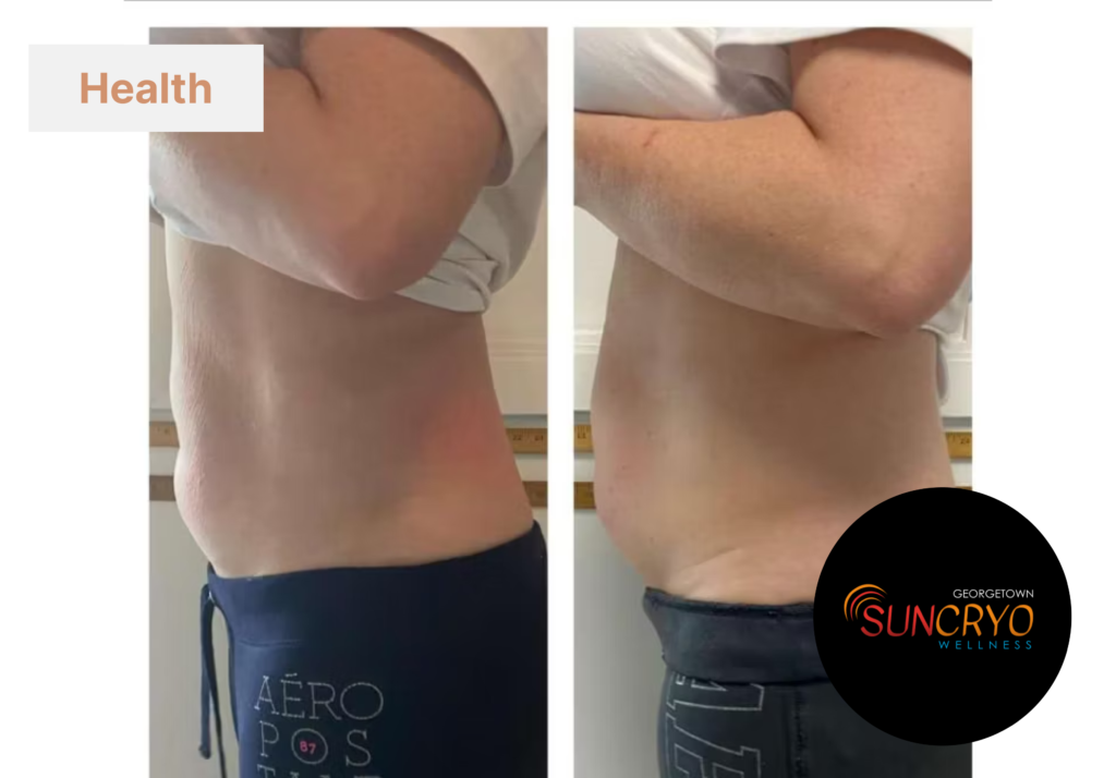 Georgetownsuncryo cryotherapy for weight management