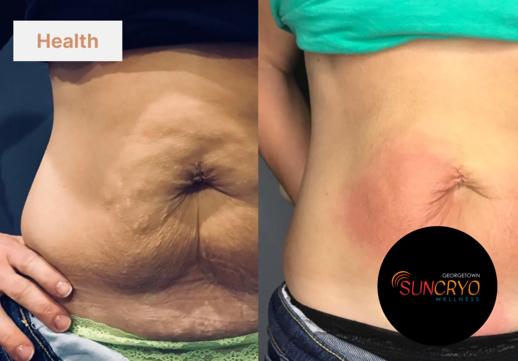 Skin tightening cryotherapy at Georgetownsuncryo