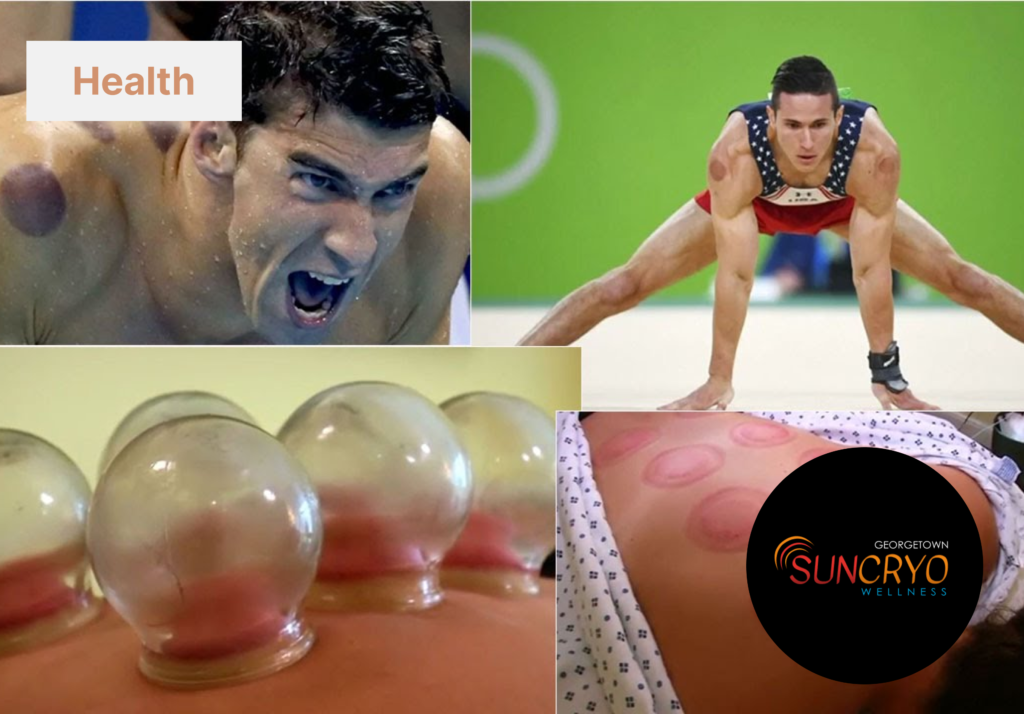georgetownsuncryo natural healing with cupping therapy