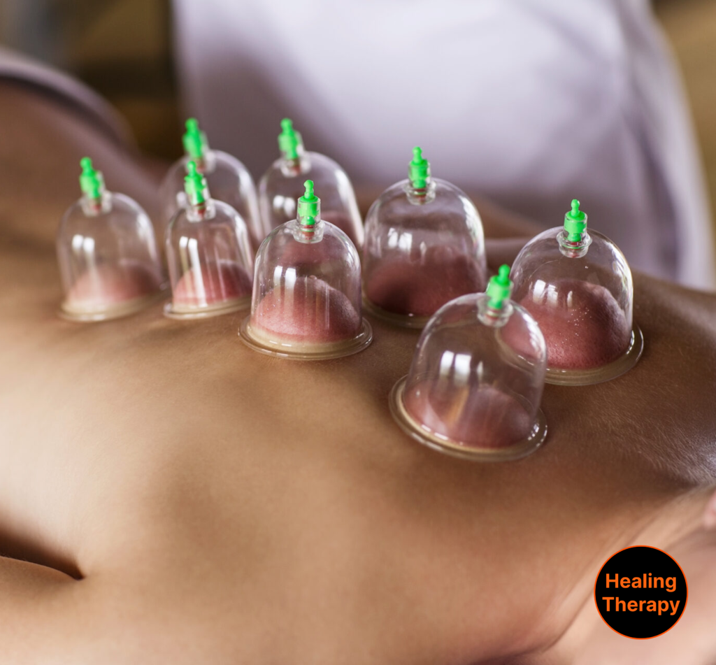 cupping-therapy-for-injury-recovery-at-georgetown-suncryo-in-washington-dc