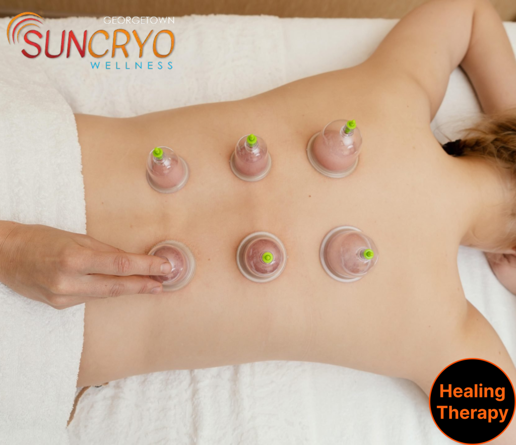 cupping-therapy-for-men-in-georgetown-dc-feel-stronger-heal-smarter-at-georgetownsuncryo