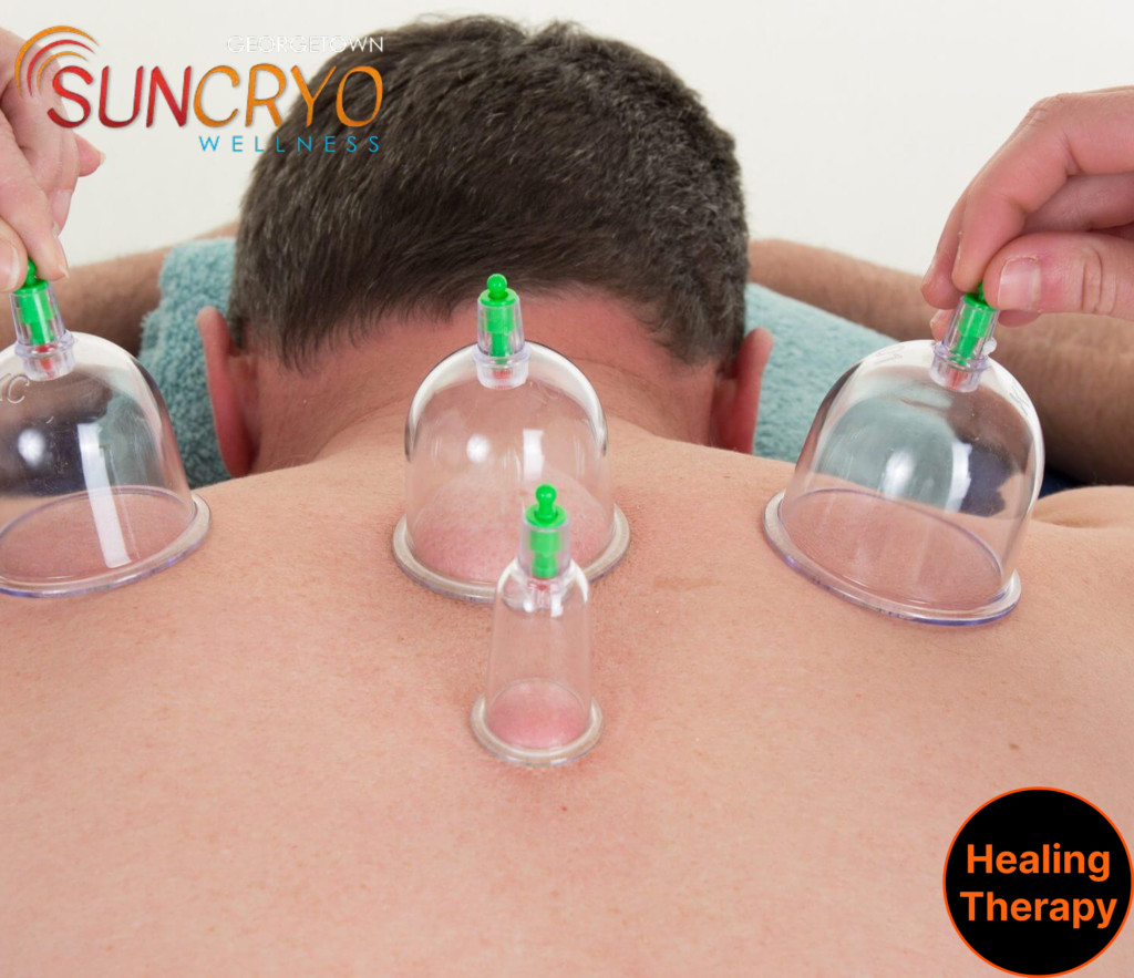 post-workout-cupping-benefits-for-athletes-at-dc-georgetown-suncryo