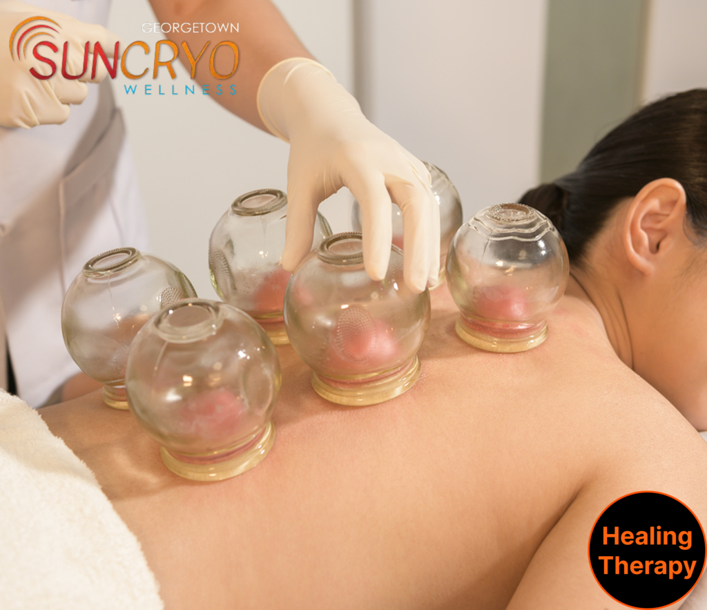 combined-fire-and-vacuum-cupping-therapy-at-georgetown-suncryo-washington-dc