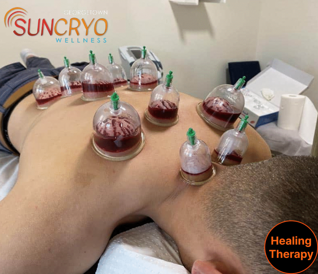 cupping-therapy-near-downtown-austin-tx-and-washington-dc-georgetown-suncryo
